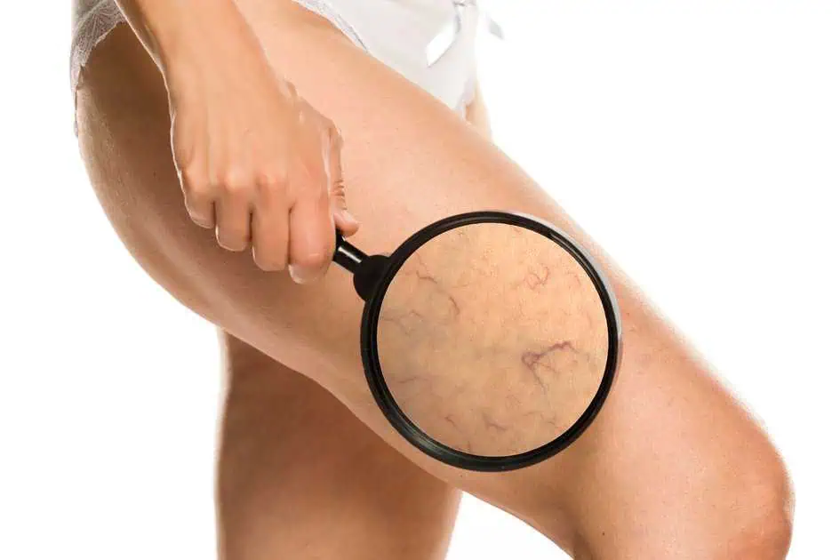 Sclerotherapy at Fit & Fabulous Spa in Princeton ,WV