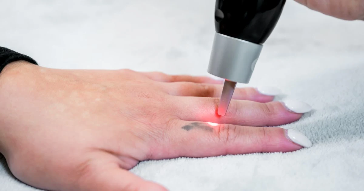 Paramedical tattooing used to blend scars into surrounding skin.