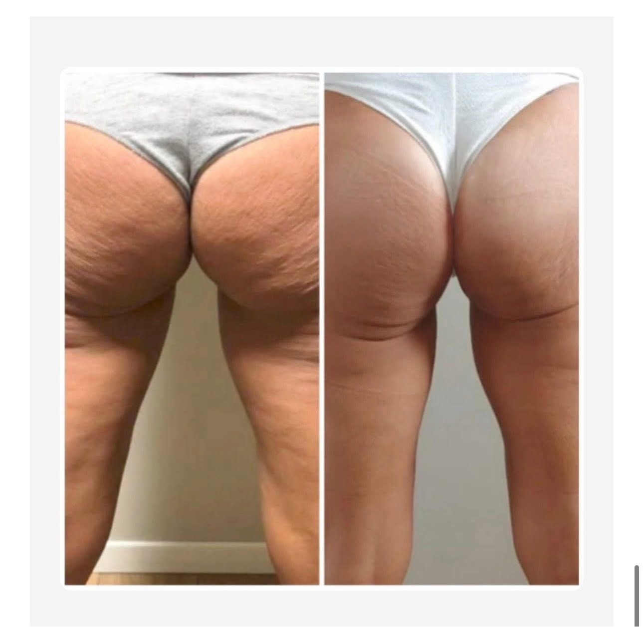 T-Shape 2 Body Sculpting Treatment in Princeton, WV | Fit & Fabulous Spa